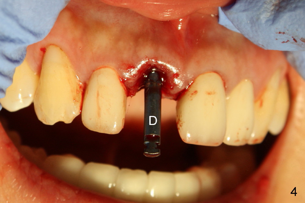 上切牙立即植牙, 门牙，upper front tooth immediate implant, Duluth, GA Dentist